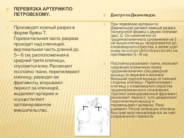 ПЕРЕВЯЗКА АРТЕРИИ ПО ПЕТРОВСКОМУ. Производят кожный разрез в форме буквы Т. Горизонтальная часть