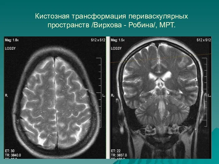 Кистозная трансформация периваскулярных пространств /Вирхова - Робина/, МРТ.