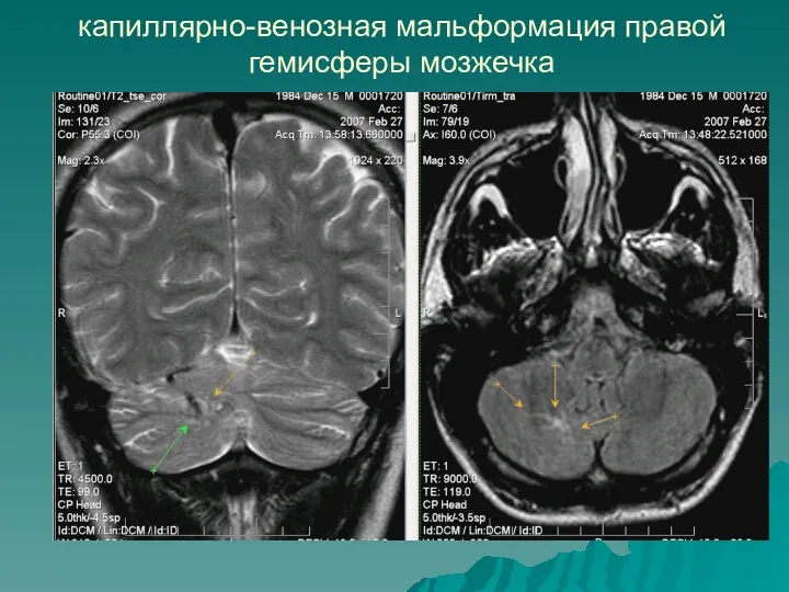 капиллярно-венозная мальформация правой гемисферы мозжечка