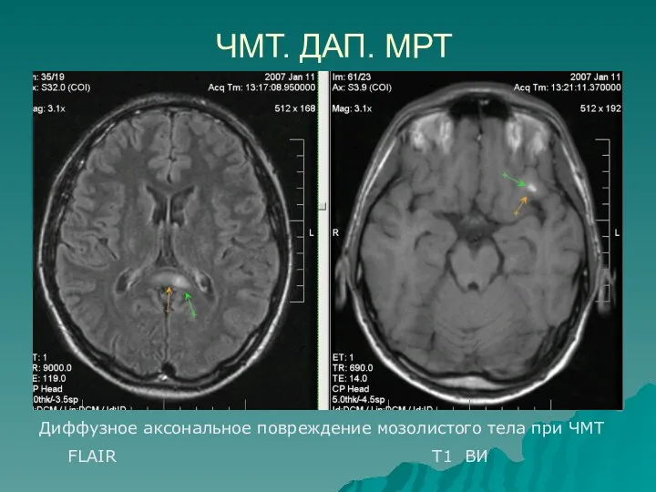 ЧМТ. ДАП. МРТ Диффузное аксональное повреждение мозолистого тела при ЧМТ FLAIR Т1 ВИ