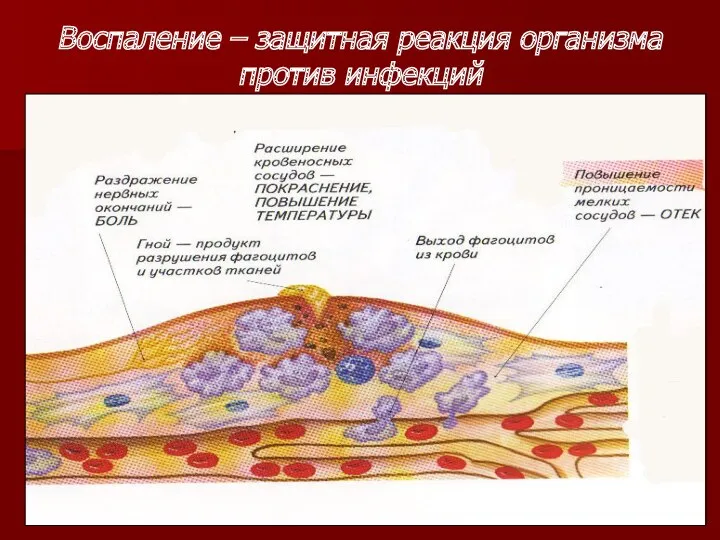 Воспаление – защитная реакция организма против инфекций