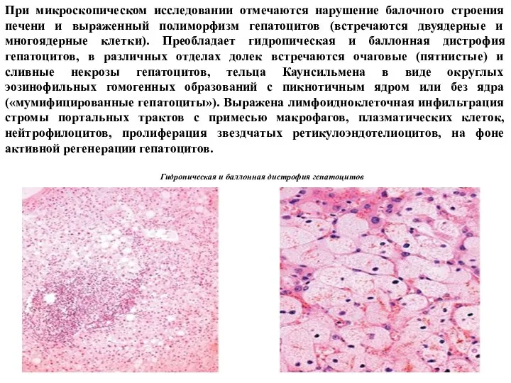 При микроскопическом исследовании отмечаются нарушение балочного строения печени и выраженный полиморфизм гепатоцитов (встречаются