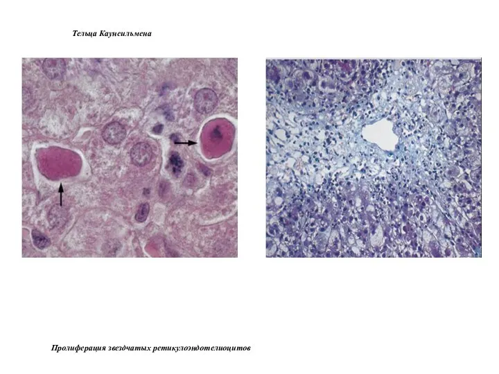 Тельца Каунсильмена Пролиферация звездчатых ретикулоэндотелиоцитов