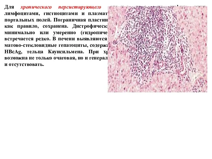 Для хронического персистирующего гепатита характерна ин­фильтрация лимфоцитами, гистиоцитами и плазматическими клетками склерозированных портальных