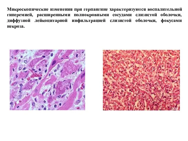 Микроскопические изменения при герпангине характеризуются воспалительной гиперемией, расширенными полнокровными сосудами слизистой оболочки, диффузной