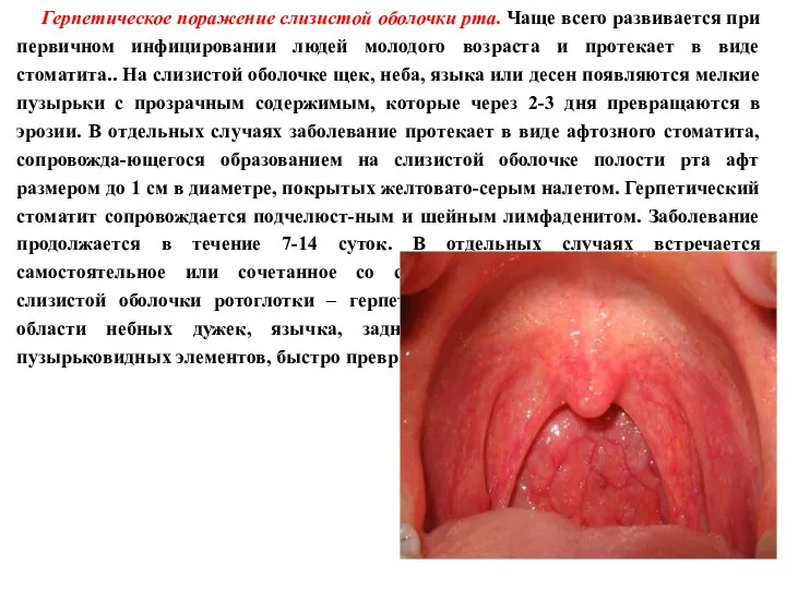 Герпетическое поражение слизистой оболочки рта. Чаще всего развивается при первичном инфицировании людей молодого