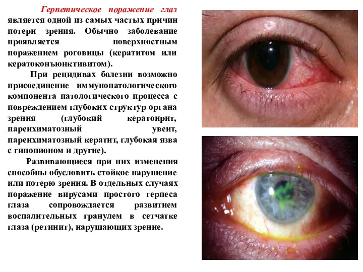 Герпетическое поражение глаз является одной из самых частых причин потери зрения. Обычно заболевание