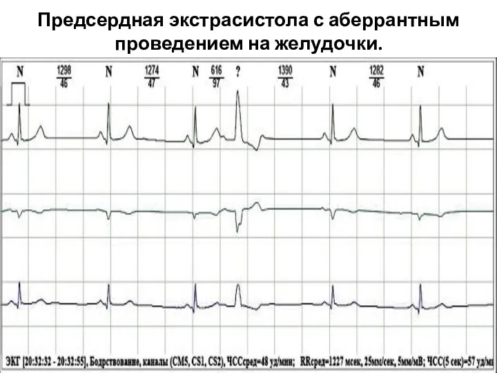 Предсердная экстрасистола с аберрантным проведением на желудочки.