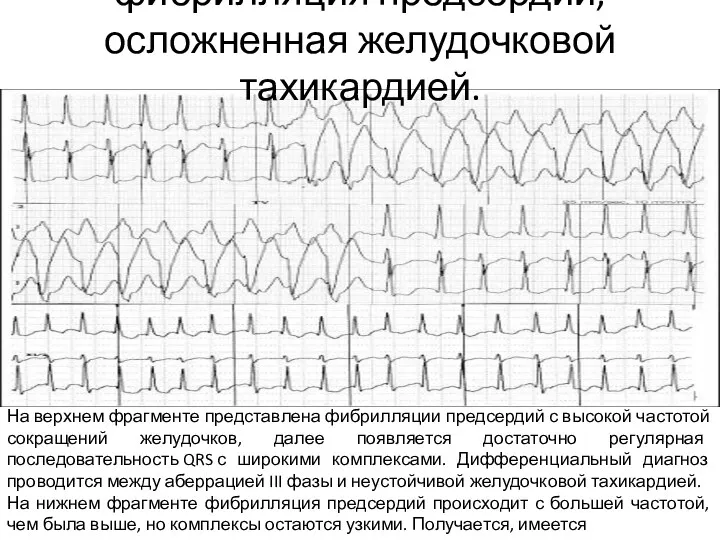 На верхнем фрагменте представлена фибрилляции предсердий с высокой частотой сокращений