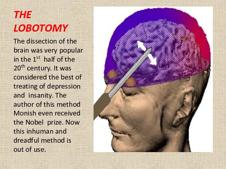 THE LOBOTOMY The dissection of the brain was very popular