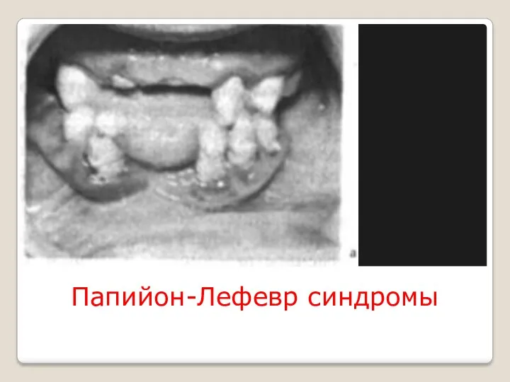 Папийон-Лефевр синдромы