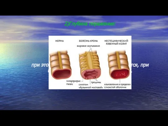 2)Глубина поражения: при этом длина кишки при НЯК укорачивается, при болезни Крона остается неизменной.