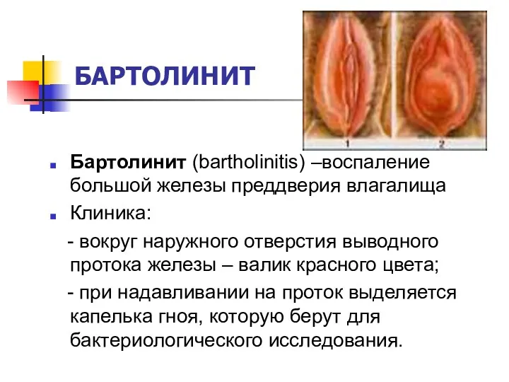 БАРТОЛИНИТ Бартолинит (bartholinitis) –воспаление большой железы преддверия влагалища Клиника: -