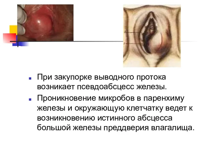 При закупорке выводного протока возникает псевдоабсцесс железы. Проникновение микробов в