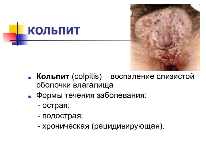 КОЛЬПИТ Кольпит (colpitis) – воспаление слизистой оболочки влагалища Формы течения