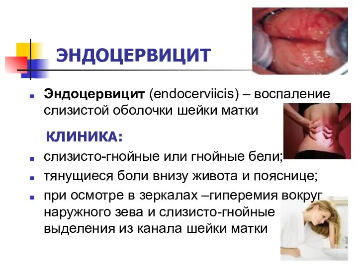 ЭНДОЦЕРВИЦИТ Эндоцервицит (endocerviicis) – воспаление слизистой оболочки шейки матки КЛИНИКА: