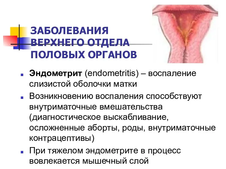 ЗАБОЛЕВАНИЯ ВЕРХНЕГО ОТДЕЛА ПОЛОВЫХ ОРГАНОВ Эндометрит (endometritis) – воспаление слизистой