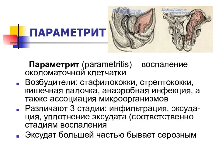 ПАРАМЕТРИТ Параметрит (parametritis) – воспаление околоматочной клетчатки Возбудители: стафилококки, стрептококки,