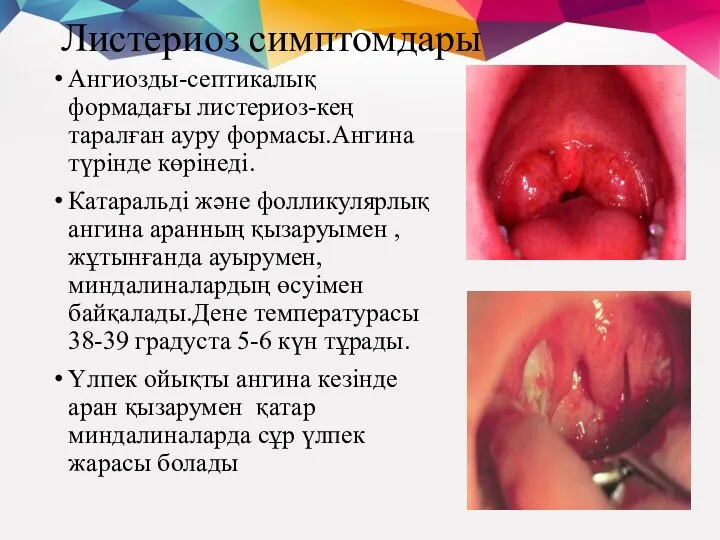 Листериоз симптомдары Ангиозды-септикалық формадағы листериоз-кең таралған ауру формасы.Ангина түрінде көрінеді.