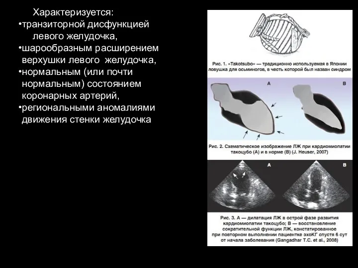 Характеризуется: транзиторной дисфункцией левого желудочка, шарообразным расширением верхушки левого желудочка,