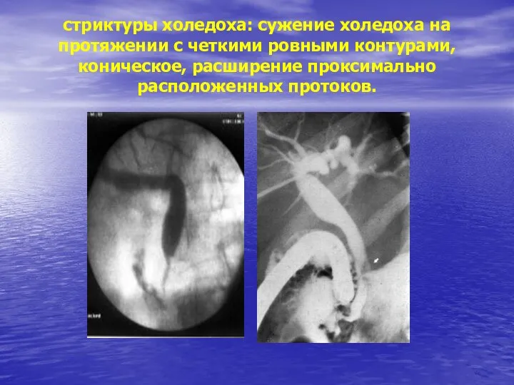 стриктуры холедоха: сужение холедоха на протяжении с четкими ровными контурами, коническое, расширение проксимально расположенных протоков.