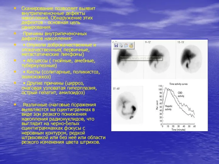 Сканирование позволяет выявит внутрипеченочные дефекты накопления. Обнаружение этих дефектов -