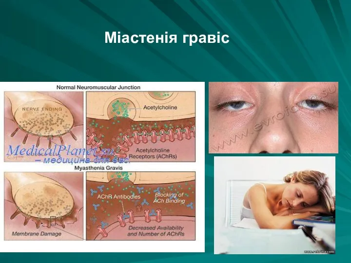 Міастенія гравіс