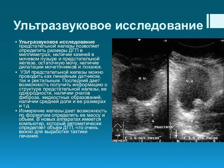 Ультразвуковое исследование Ультразвуковое исследование предстательной железы позволяет определить размеры ДГП