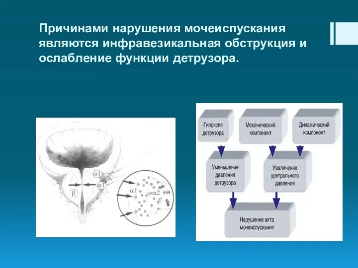 Причинами нарушения мочеиспускания являются инфравезикальная обструкция и ослабление функции детрузора.