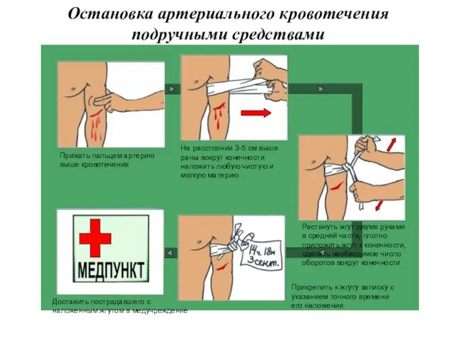 Остановка артериального кровотечения подручными средствами Прижать пальцем артерию выше кровотечения