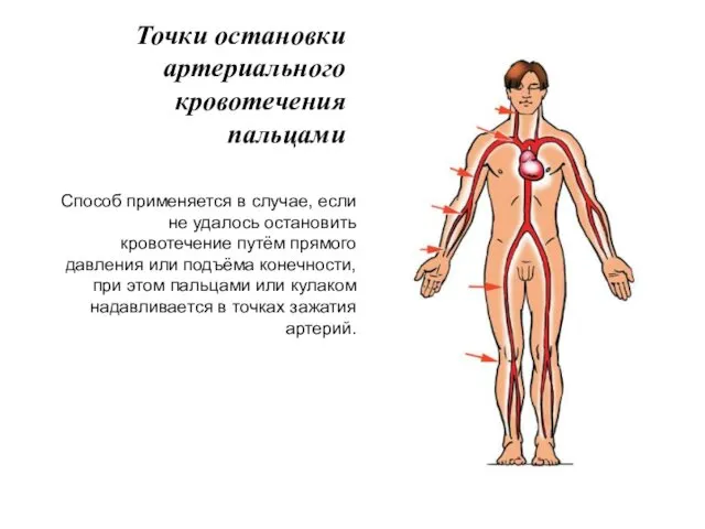 Точки остановки артериального кровотечения пальцами Способ применяется в случае, если