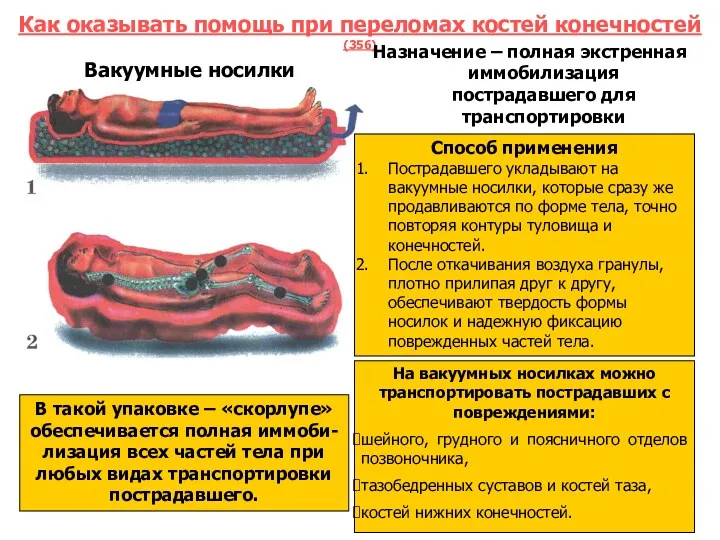 Как оказывать помощь при переломах костей конечностей (356) Вакуумные носилки