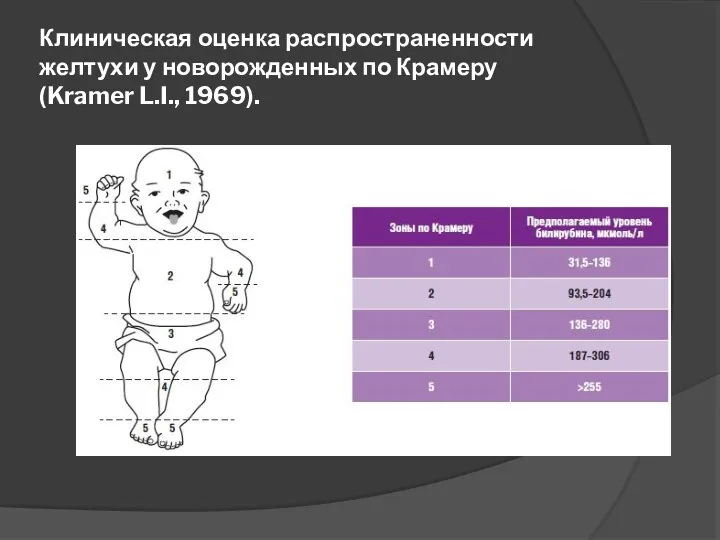 Клиническая оценка распространенности желтухи у новорожденных по Крамеру (Kramer L.I., 1969).