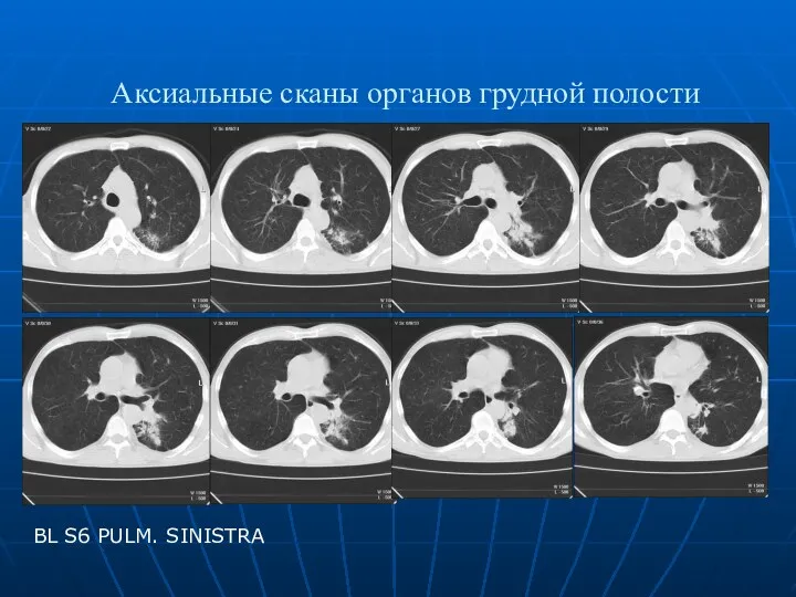 Аксиальные сканы органов грудной полости BL S6 PULM. SINISTRA