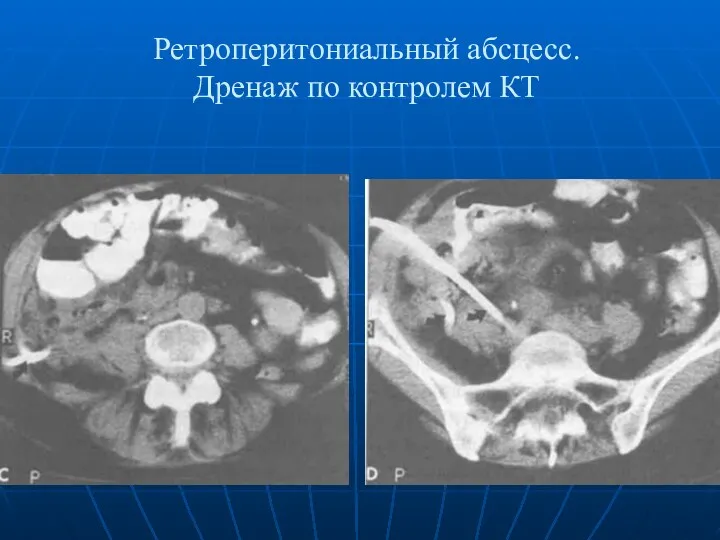 Ретроперитониальный абсцесс. Дренаж по контролем КТ