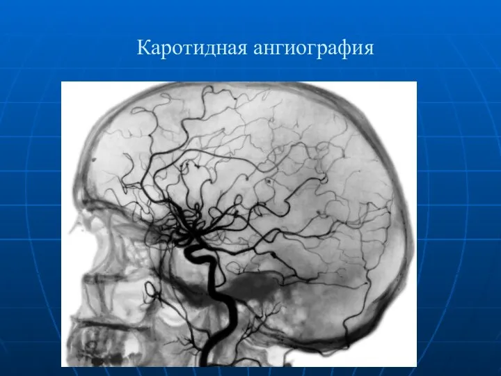 Каротидная ангиография