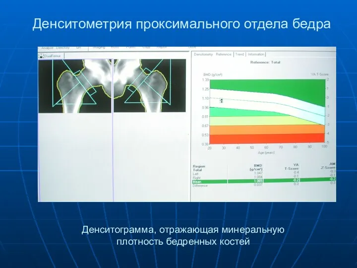 Денситометрия проксимального отдела бедра Денситограмма, отражающая минеральную плотность бедренных костей