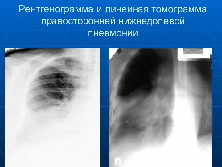 Рентгенограмма и линейная томограмма правосторонней нижнедолевой пневмонии
