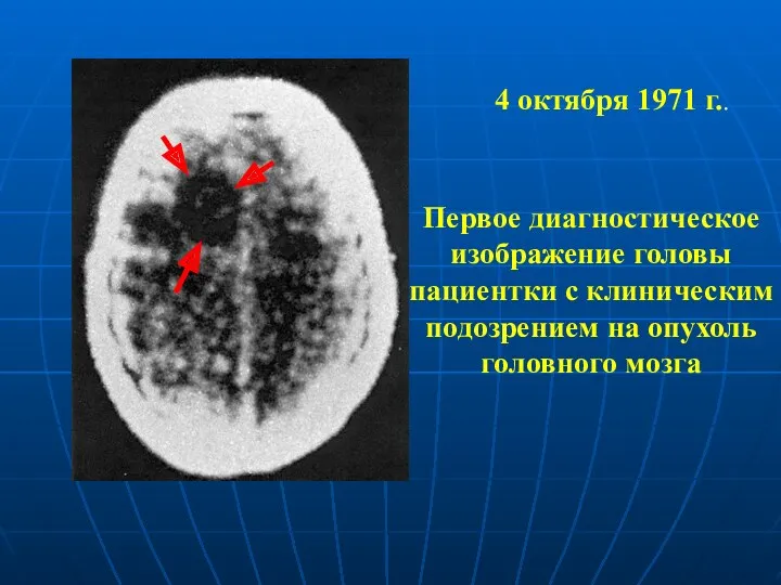 4 октября 1971 г.. Первое диагностическое изображение головы пациентки с клиническим подозрением на опухоль головного мозга