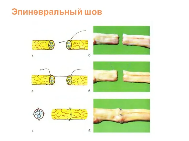 Эпиневральный шов