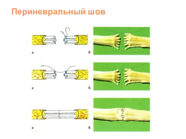 Периневральный шов