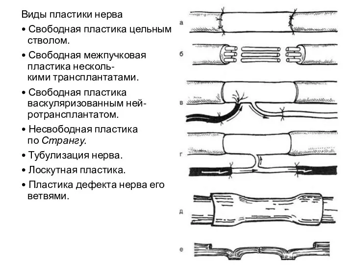 Виды пластики нерва • Свободная пластика цельным стволом. • Свободная межпучковая пластика несколь-