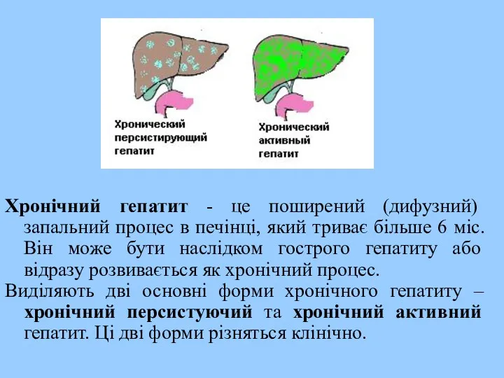 Хронічний гепатит - це поширений (дифузний) запальний процес в печінці,