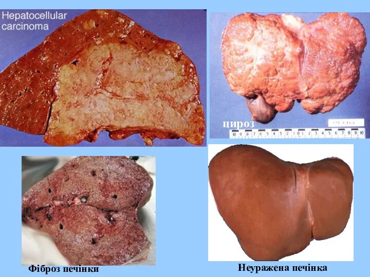 цироз Неуражена печінка Фіброз печінки