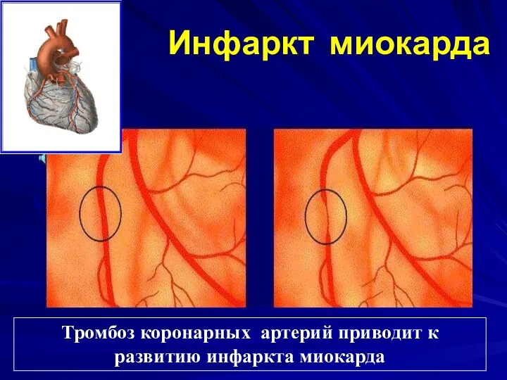 Инфаркт миокарда Тромбоз коронарных артерий приводит к развитию инфаркта миокарда