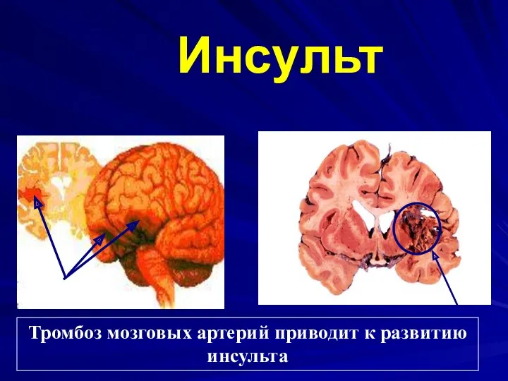 Инсульт Тромбоз мозговых артерий приводит к развитию инсульта