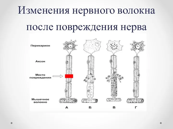 Изменения нервного волокна после повреждения нерва