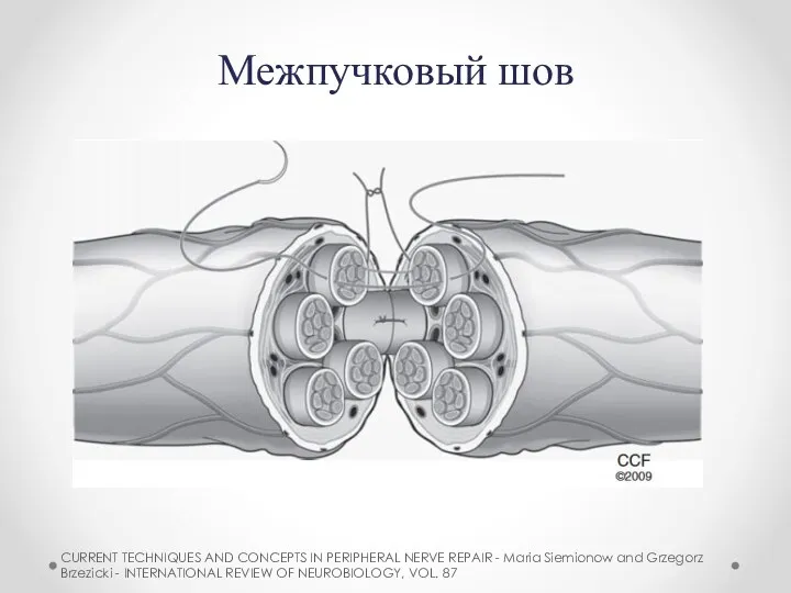 Межпучковый шов CURRENT TECHNIQUES AND CONCEPTS IN PERIPHERAL NERVE REPAIR