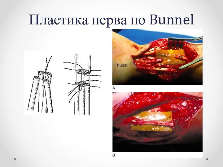 Пластика нерва по Bunnel