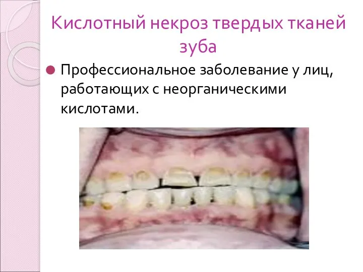 Кислотный некроз твердых тканей зуба Профессиональное заболевание у лиц, работающих с неорганическими кислотами.